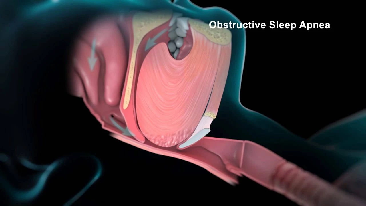 The connection between sleep apnea and blood clots in stents